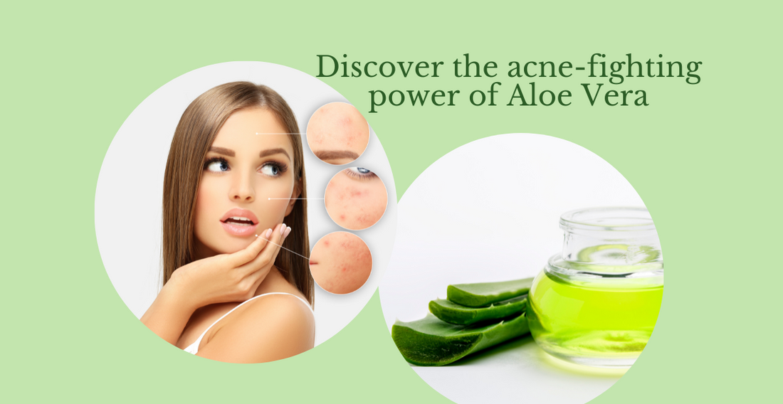 Reduce Acne & Have Clearer Skin Naturally With Aloe Vera Gel